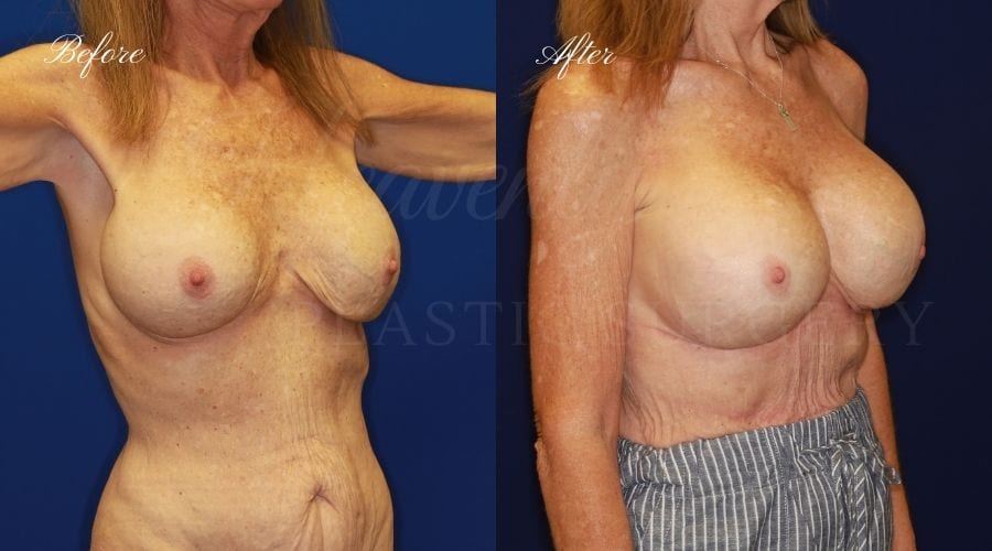 Plastic surgery, plastic surgeon, breast surgery, breast implant revision, deflated breast implant, breast augmentation correction, implant exchange, breast implants, implant exchange, breast implant exchange