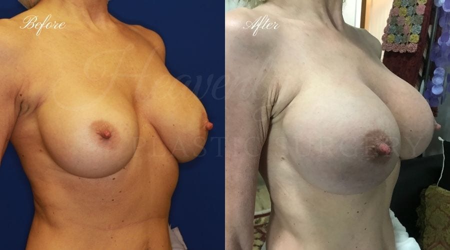 Plastic surgery, plastic surgeon, breast surgery, breast implant revision, deflated breast implant, breast augmentation correction