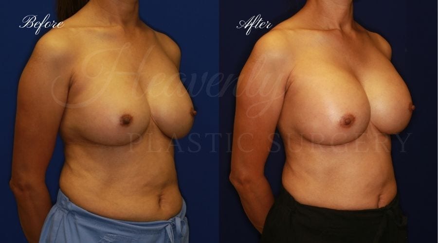 Plastic surgery, plastic surgeon, breast surgery, breast implant revision, deflated breast implant, breast augmentation correction, implant exchange, breast implants, implant exchange, breast implant exchange Plastic surgery, plastic surgeon, breast surgery, breast implant revision, deflated breast implant, breast augmentation correction, implant exchange, breast implants, implant exchange, breast implant exchange