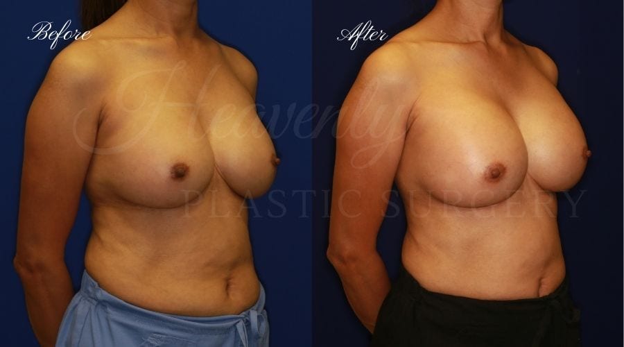 Plastic surgery, plastic surgeon, breast surgery, breast implant revision, deflated breast implant, breast augmentation correction, implant exchange, breast implants, implant exchange, breast implant exchange