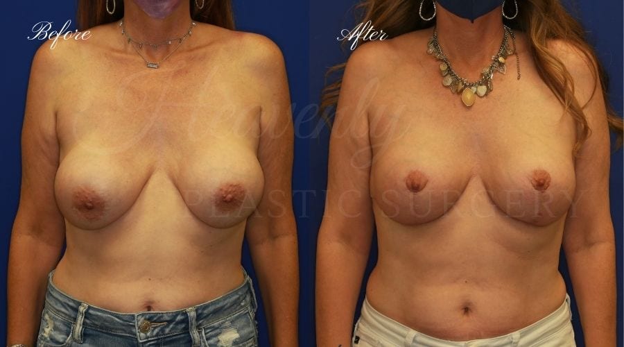 Breast Implant Exchange and Breast Lift - 310cc SRM Silicone Implants with Wise pattern Mastopexy (Anchor Scar)