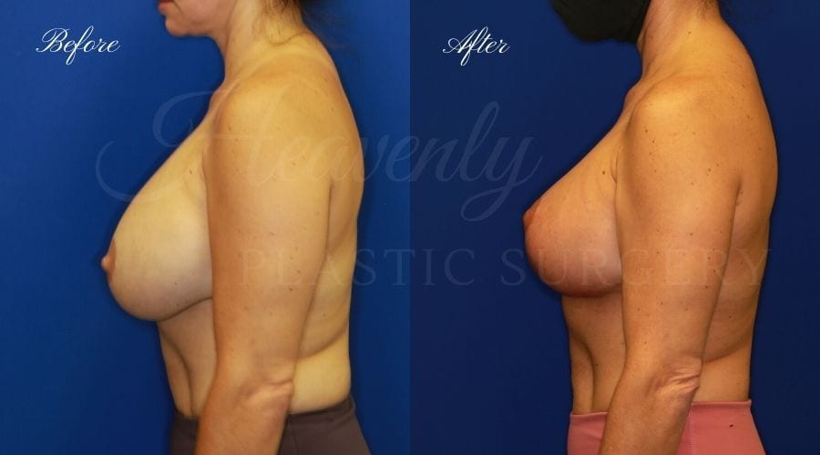 Breast Implant Exchange and Breast Lift - 310cc SRM Silicone Implants with Wise pattern Mastopexy (Anchor Scar)