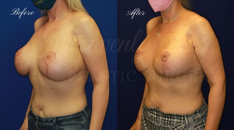 Breast Implant Exchange and Breast Lift - 310cc SRM Silicone Implants with Wise pattern Mastopexy (Anchor Scar)