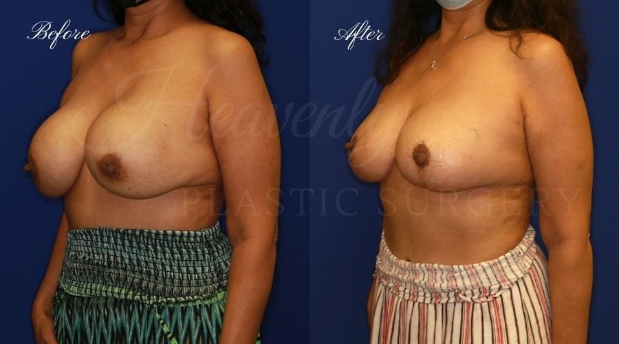 Breast Implant Exchange and Breast Lift - 310cc SRM Silicone Implants with Wise pattern Mastopexy (Anchor Scar) Breast Implant Exchange and Breast Lift - 310cc SRM Silicone Implants with Wise pattern Mastopexy (Anchor Scar)