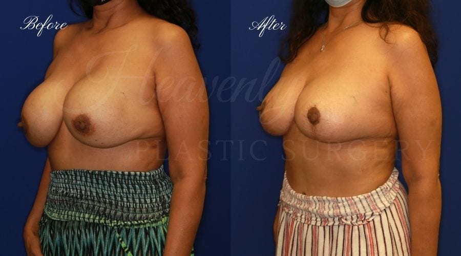 Breast Implant Exchange and Breast Lift - 310cc SRM Silicone Implants with Wise pattern Mastopexy (Anchor Scar)