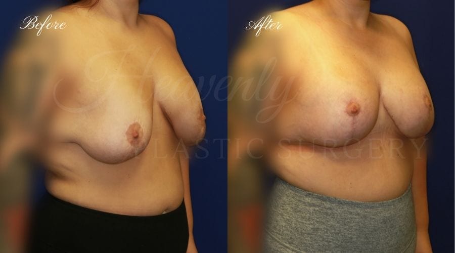 Breast Implant Exchange and Breast Lift - 310cc SRM Silicone Implants with Wise pattern Mastopexy (Anchor Scar)