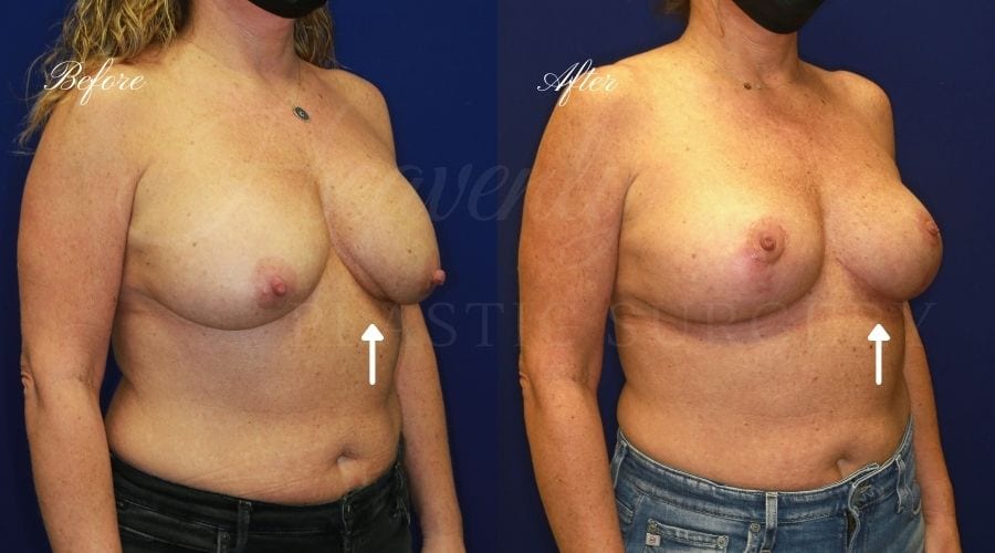 Breast Implant Exchange and Breast Lift - 310cc SRM Silicone Implants with Wise pattern Mastopexy (Anchor Scar)