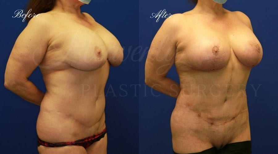 Breast Implant Exchange and Breast Lift - 310cc SRM Silicone Implants with Wise pattern Mastopexy (Anchor Scar)