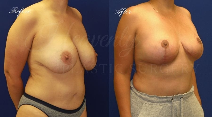 Breast Implant Exchange and Breast Lift - 310cc SRM Silicone Implants with Wise pattern Mastopexy (Anchor Scar)