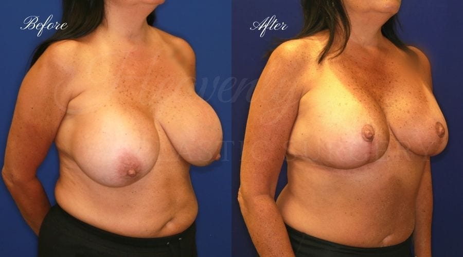 Breast Implant Exchange and Breast Lift - 310cc SRM Silicone Implants with Wise pattern Mastopexy (Anchor Scar)