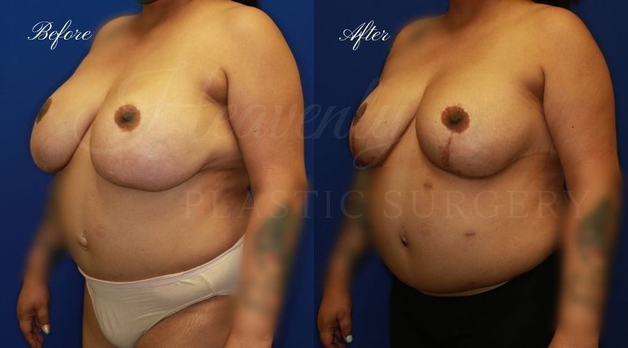 Implant Exchange + Breast Lift Revision Before and After - Left Oblique ANDE Implant Exchange + Breast Lift Before and After -, Plastic Surgery, Plastic Surgeon, Breast Implant Exchange with Breast LIft, Breast Surgery, Breast surgery before and after, breast implant exchange with lift before and after, plastic surgery orange county, plastic surgeon orange county