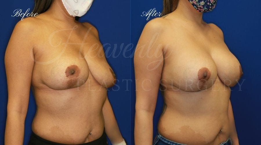 Breast Implant Exchange and Breast Lift - 310cc SRM Silicone Implants with Wise pattern Mastopexy (Anchor Scar)