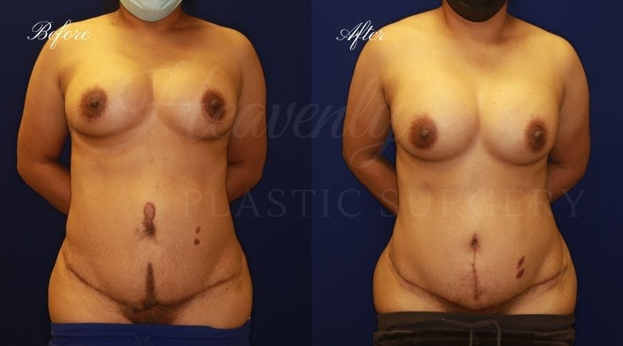 Plastic surgery, plastic surgeon, breast surgery, breast implant revision, deflated breast implant, breast augmentation correction