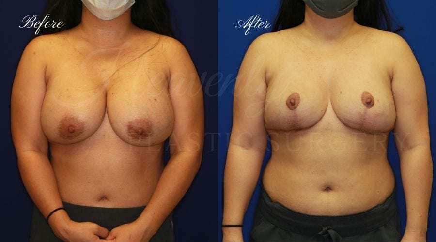 Breast Implant Removal + Breast Lift, Explant and Breast Lift, Breast Explant, Mastopexy, IMplant removal and mastopexy, plastic surgery before and after, plastic surgery revision, implant removal before and after, breast implant removal before and after, breast implant removal surgeon, breast implant removal orange county Breast Implant Removal + Breast Lift, Explant and Breast Lift, Breast Explant, Mastopexy, IMplant removal and mastopexy, plastic surgery before and after, plastic surgery revision, implant removal before and after, breast implant removal before and after, breast implant removal surgeon, breast implant removal orange county