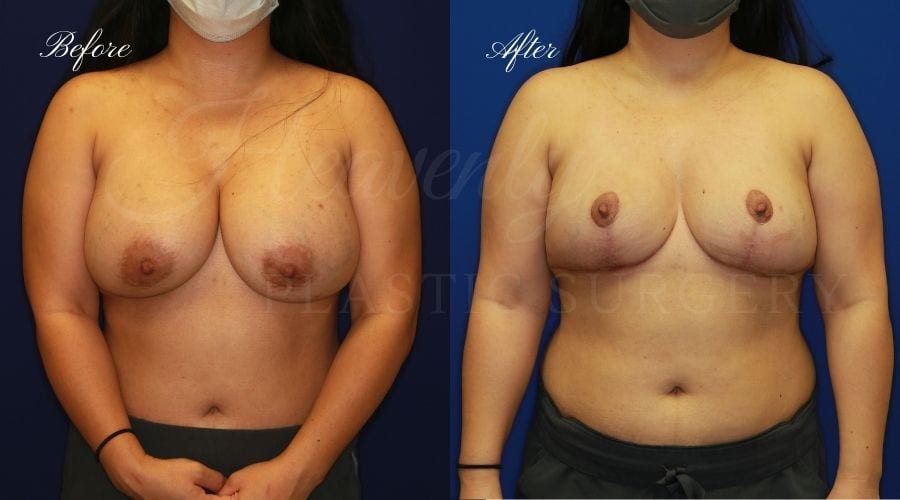 Breast Implant Removal + Breast Lift, Explant and Breast Lift, Breast Explant, Mastopexy, IMplant removal and mastopexy, plastic surgery before and after, plastic surgery revision, implant removal before and after, breast implant removal before and after, breast implant removal surgeon, breast implant removal orange county