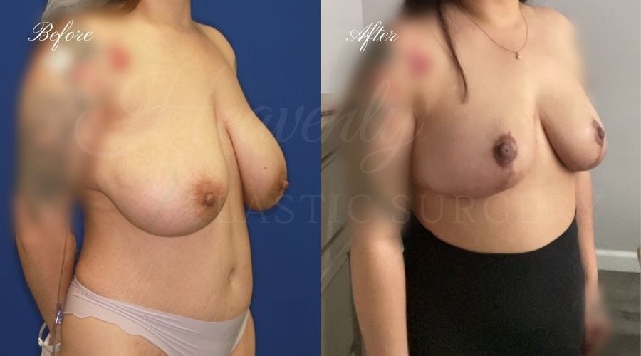 Breast Implant Removal + Breast Lift, Explant and Breast Lift, Breast Explant, Mastopexy, IMplant removal and mastopexy, plastic surgery before and after, plastic surgery revision, implant removal before and after, breast implant removal before and after, breast implant removal surgeon, breast implant removal orange county