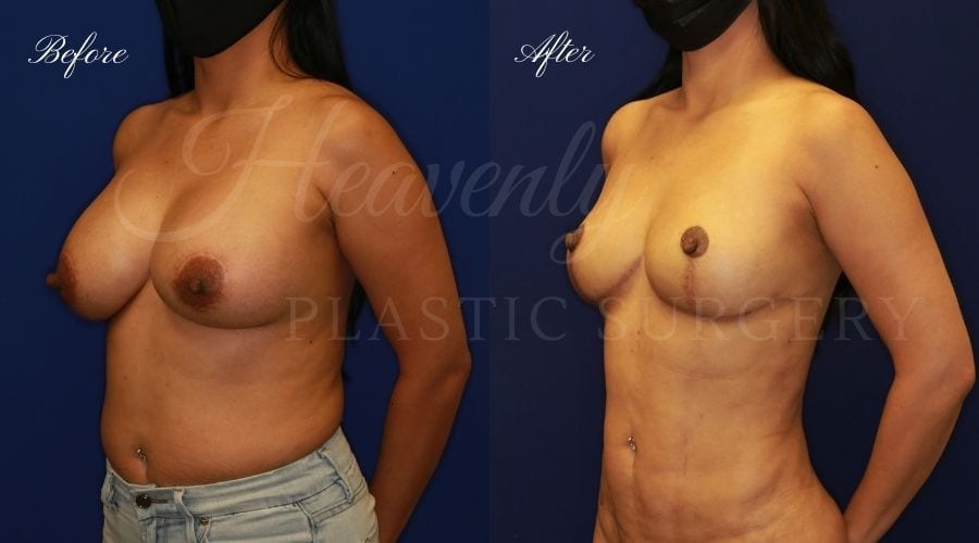 Breast Implant Removal + Breast Lift, Explant and Breast Lift, Breast Explant, Mastopexy, IMplant removal and mastopexy, plastic surgery before and after, plastic surgery revision, implant removal before and after, breast implant removal before and after, breast implant removal surgeon, breast implant removal orange county