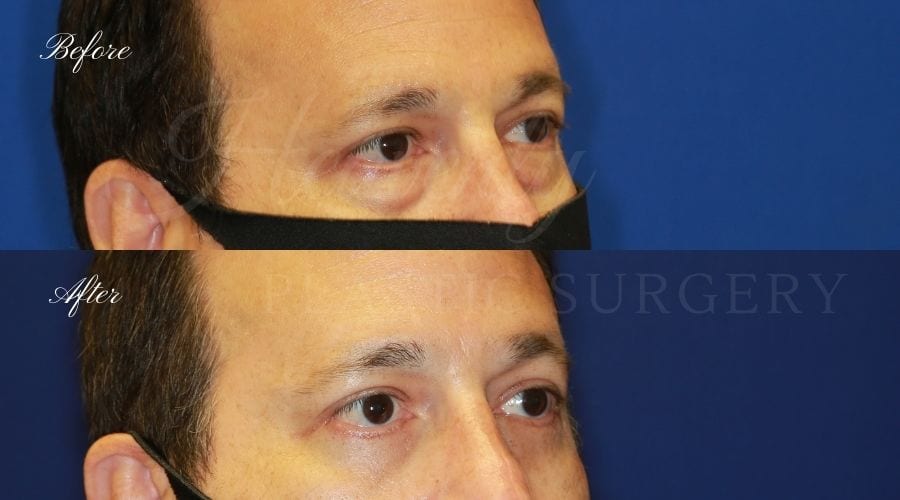 Plastic surgeon, plastic surgery, upper blepharoplasty, eyelid surgery, lower blepharoplasty, droopy eyelids