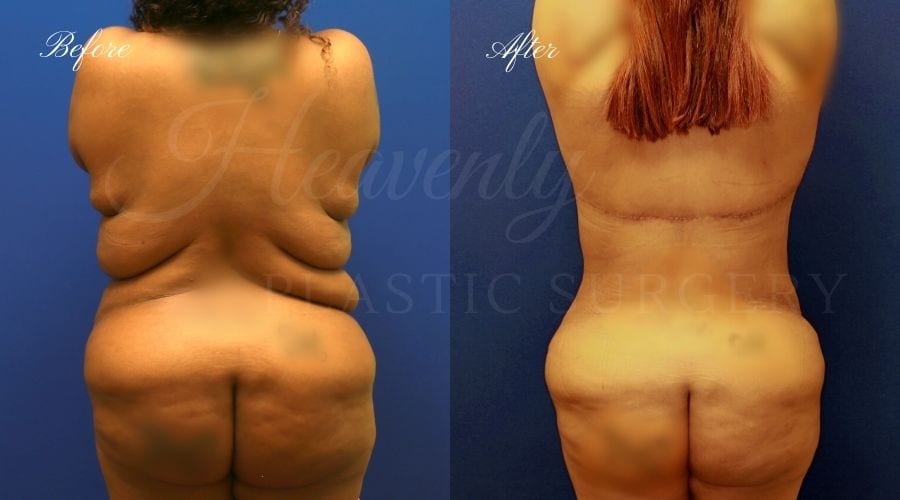 Mommy Makeover before and after, tummy tuck before and after, back lift before and after, upper body lift before and after, mommy makeover results, back lift results, mommy makeover recovery, mommy makeover journey, mommy makeover surgeon, tummy tuck surgeon, back lift surgeon, upper body lift surgeon, upper body lift surgery, tummy tuck surgery, tummy tuck orange county, back lift orange county Mommy Makeover before and after, tummy tuck before and after, back lift before and after, upper body lift before and after, mommy makeover results, back lift results, mommy makeover recovery, mommy makeover journey, mommy makeover surgeon, tummy tuck surgeon, back lift surgeon, upper body lift surgeon, upper body lift surgery, tummy tuck surgery, tummy tuck orange county, back lift orange county