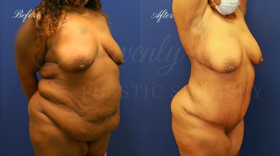 Mommy Makeover before and after, tummy tuck before and after, back lift before and after, upper body lift before and after, mommy makeover results, back lift results, mommy makeover recovery, mommy makeover journey, mommy makeover surgeon, tummy tuck surgeon, back lift surgeon, upper body lift surgeon, upper body lift surgery, tummy tuck surgery, tummy tuck orange county, back lift orange county Mommy Makeover before and after, tummy tuck before and after, back lift before and after, upper body lift before and after, mommy makeover results, back lift results, mommy makeover recovery, mommy makeover journey, mommy makeover surgeon, tummy tuck surgeon, back lift surgeon, upper body lift surgeon, upper body lift surgery, tummy tuck surgery, tummy tuck orange county, back lift orange county