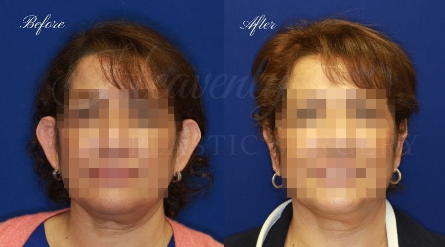 Otoplasty Before and After, Otoplasty results, ear pinning surgery, ear pinning before and after, ear pinning results, otoplasty surgeon, otoplasty surgery, otoplasty orange county, ear pinning surgeon, ear surgery Otoplasty Before and After, Otoplasty results, ear pinning surgery, ear pinning before and after, ear pinning results, otoplasty surgeon, otoplasty surgery, otoplasty orange county, ear pinning surgeon, ear surgery