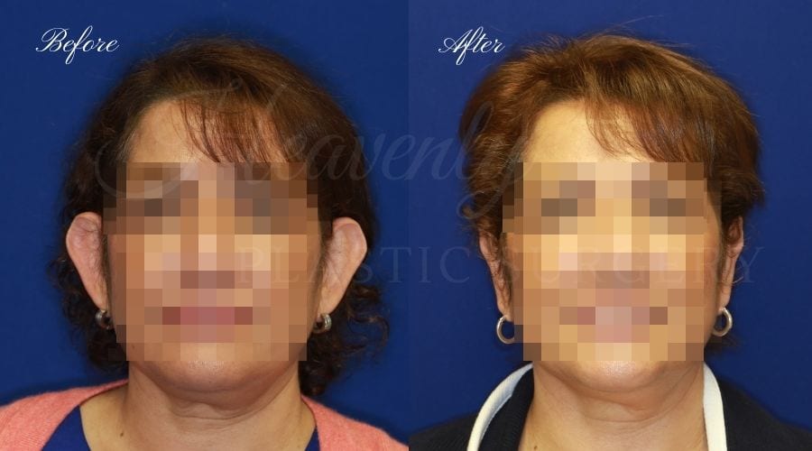 Otoplasty Before and After, Otoplasty results, ear pinning surgery, ear pinning before and after, ear pinning results, otoplasty surgeon, otoplasty surgery, otoplasty orange county, ear pinning surgeon, ear surgery