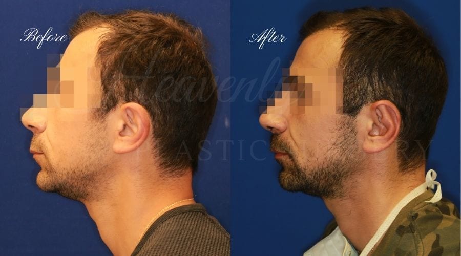 Otoplasty Before and After, Otoplasty results, ear pinning surgery, ear pinning before and after, ear pinning results, otoplasty surgeon, otoplasty surgery, otoplasty orange county, ear pinning surgeon, ear surgery