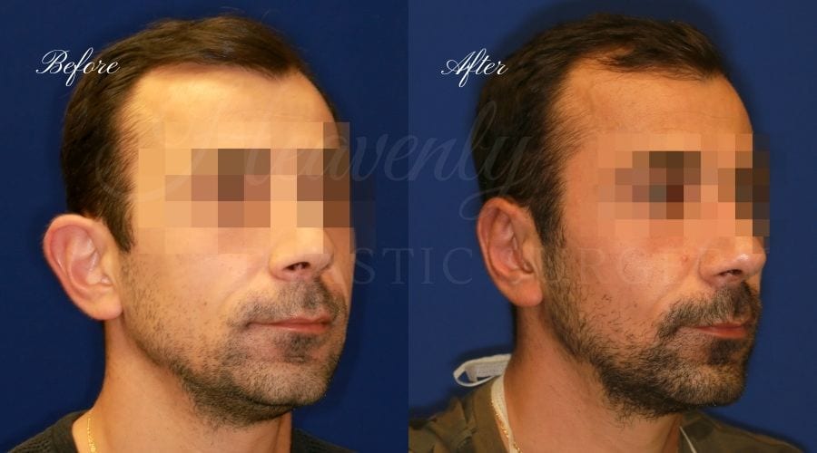 Otoplasty Before and After, Otoplasty results, ear pinning surgery, ear pinning before and after, ear pinning results, otoplasty surgeon, otoplasty surgery, otoplasty orange county, ear pinning surgeon, ear surgery