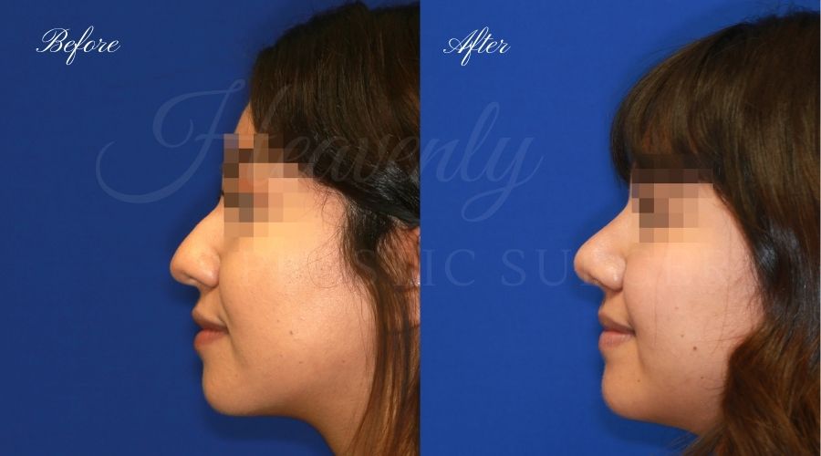 rhinoplasty, rhinoplasty before and after, rhinoplasty results, rhinoplasty orange county, nose job, nose job before and after, plastic surgery before and after, before and after, rhinoplasty surgeon, nose job surgeon, plastic surgery check