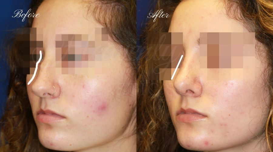 rhinoplasty, rhinoplasty before and after, rhinoplasty results, rhinoplasty orange county, nose job, nose job before and after, plastic surgery before and after, before and after, rhinoplasty surgeon, nose job surgeon, plastic surgery check rhinoplasty, rhinoplasty before and after, rhinoplasty results, rhinoplasty orange county, nose job, nose job before and after, plastic surgery before and after, before and after, rhinoplasty surgeon, nose job surgeon, plastic surgery check