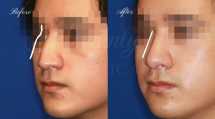 rhinoplasty, rhinoplasty before and after, rhinoplasty results, rhinoplasty orange county, nose job, nose job before and after, plastic surgery before and after, before and after, rhinoplasty surgeon, nose job surgeon, plastic surgery check