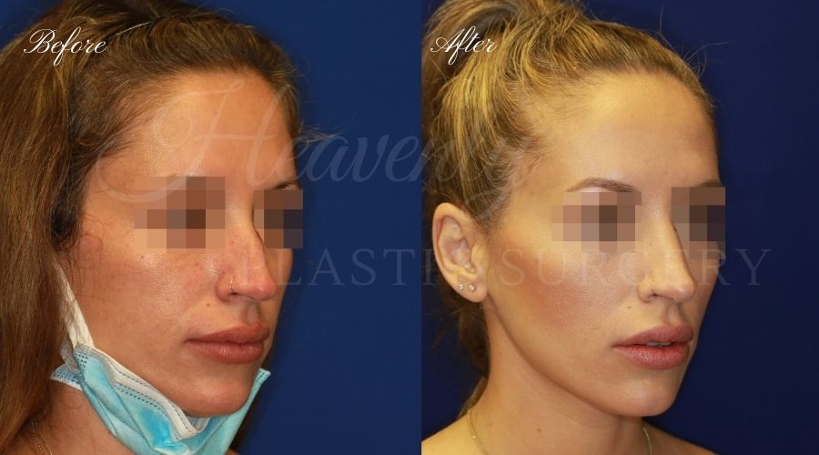 rhinoplasty, rhinoplasty before and after, rhinoplasty results, rhinoplasty orange county, nose job, nose job before and after, plastic surgery before and after, before and after, rhinoplasty surgeon, nose job surgeon, plastic surgery check