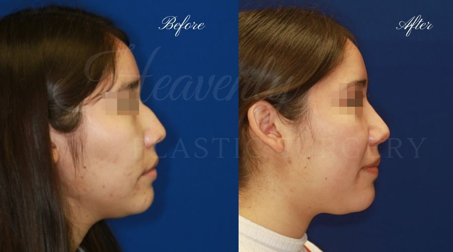 rhinoplasty, rhinoplasty before and after, rhinoplasty results, rhinoplasty orange county, nose job, nose job before and after, plastic surgery before and after, before and after, rhinoplasty surgeon, nose job surgeon, plastic surgery check