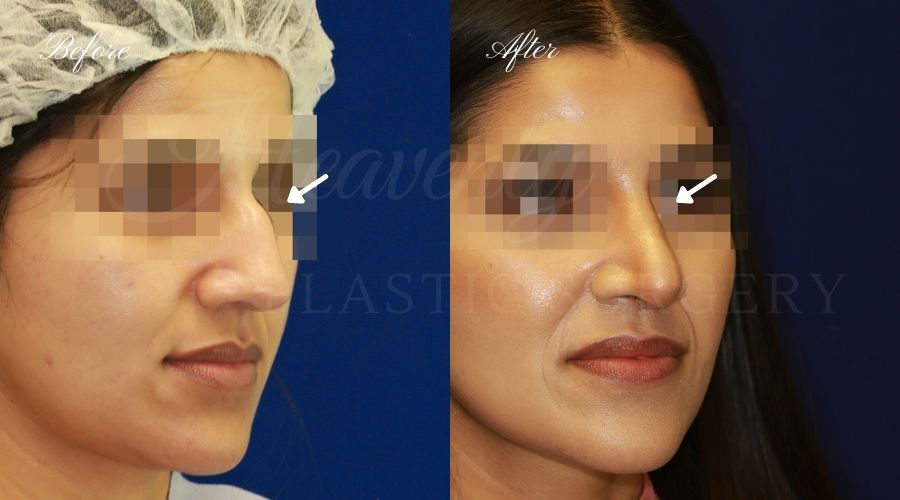 rhinoplasty, rhinoplasty before and after, rhinoplasty results, rhinoplasty orange county, nose job, nose job before and after, plastic surgery before and after, before and after, rhinoplasty surgeon, nose job surgeon, plastic surgery check