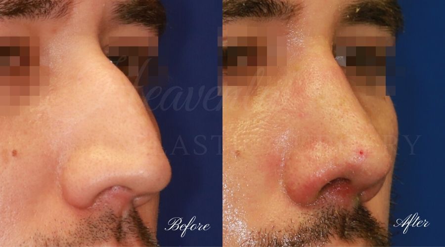 rhinoplasty, rhinoplasty before and after, rhinoplasty results, rhinoplasty orange county, nose job, nose job before and after, plastic surgery before and after, before and after, rhinoplasty surgeon, nose job surgeon, plastic surgery check