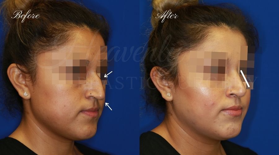 rhinoplasty, rhinoplasty before and after, rhinoplasty results, rhinoplasty orange county, nose job, nose job before and after, plastic surgery before and after, before and after, rhinoplasty surgeon, nose job surgeon, plastic surgery check