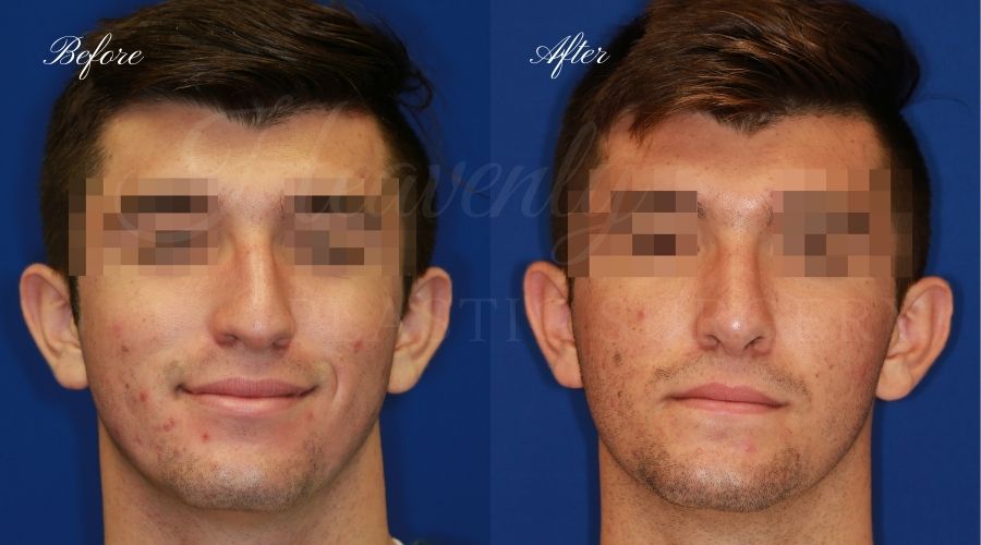 rhinoplasty, rhinoplasty before and after, rhinoplasty results, rhinoplasty orange county, nose job, nose job before and after, plastic surgery before and after, before and after, rhinoplasty surgeon, nose job surgeon, plastic surgery check