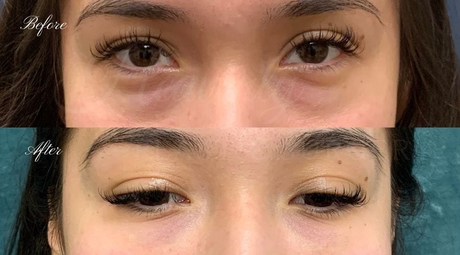 Tear trough filler, undereye filler, eye filler, dermal filler, nurse injector, medspa, filler medspa, filler orange county, under eye filler orange county, filler orange county Tear trough filler, undereye filler, eye filler, dermal filler, nurse injector, medspa, filler medspa, filler orange county, under eye filler orange county, filler orange county