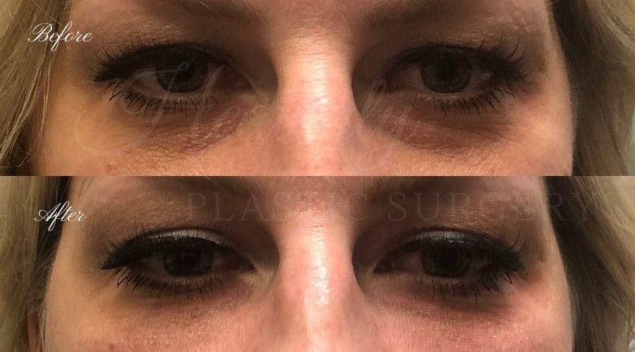 Tear trough filler, undereye filler, eye filler, dermal filler, nurse injector, medspa, filler medspa, filler orange county, under eye filler orange county, filler orange county Tear trough filler, undereye filler, eye filler, dermal filler, nurse injector, medspa, filler medspa, filler orange county, under eye filler orange county, filler orange county