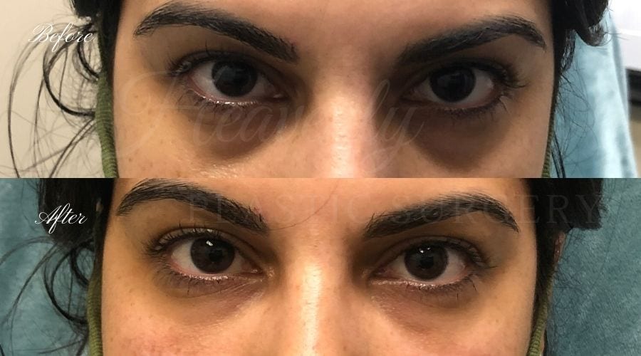 Tear trough filler, undereye filler, eye filler, dermal filler, nurse injector, medspa, filler medspa, filler orange county, under eye filler orange county, filler orange county Tear trough filler, undereye filler, eye filler, dermal filler, nurse injector, medspa, filler medspa, filler orange county, under eye filler orange county, filler orange county