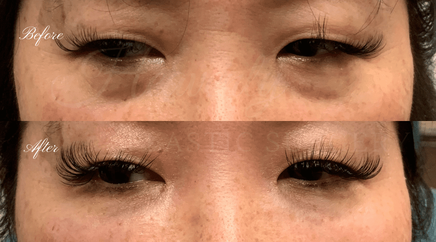Tear trough filler, undereye filler, eye filler, dermal filler, nurse injector, medspa, filler medspa, filler orange county, under eye filler orange county, filler orange county Tear trough filler, undereye filler, eye filler, dermal filler, nurse injector, medspa, filler medspa, filler orange county, under eye filler orange county, filler orange county