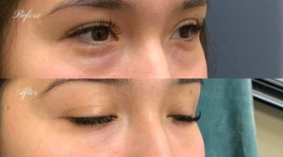 Tear trough filler, undereye filler, eye filler, dermal filler, nurse injector, medspa, filler medspa, filler orange county, under eye filler orange county, filler orange county Tear trough filler, undereye filler, eye filler, dermal filler, nurse injector, medspa, filler medspa, filler orange county, under eye filler orange county, filler orange county