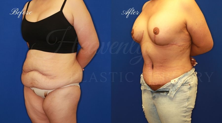 Plastic Surgery, Plastic Surgeon, Tummy Tuck, Abdominoplasty, Tummy Tuck with Lipo, Liposuction, Orange County Plastic Surgeon, Orange County Plastic Surgery, Fupa, Fupa surgery