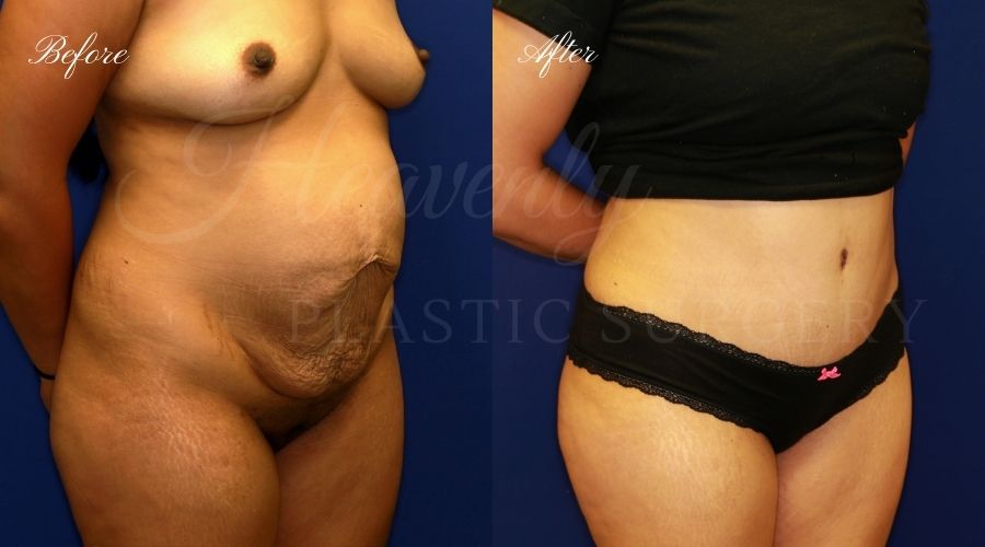 Plastic Surgery, Plastic Surgeon, Tummy Tuck, Abdominoplasty, Tummy Tuck with Lipo, Liposuction, Orange County Plastic Surgeon, Orange County Plastic Surgery, Fupa, Fupa surgery