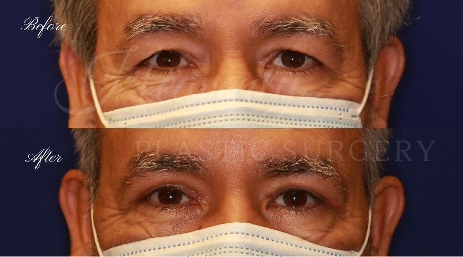 Plastic Surgery, Plastic Surgeon, Eyelid Surgery, Upper blepharoplasty, blepharoplasty, upper eyelids, upper eyelid surgery