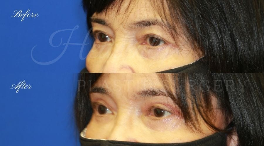 Plastic surgeon, plastic surgery, upper blepharoplasty, eyelid surgery