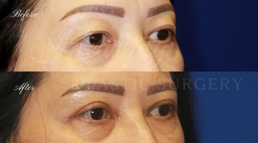 Plastic Surgery, Plastic Surgeon, Eyelid Surgery, Upper blepharoplasty, blepharoplasty, upper eyelids, upper eyelid surgery