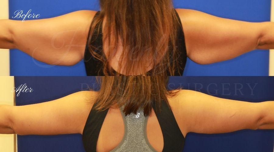 Plastic Surgery, Liposuction, Arm Lift, Brachioplasty, arms, bat wings Plastic Surgery, Liposuction, Arm Lift, Brachioplasty, arms, bat wings