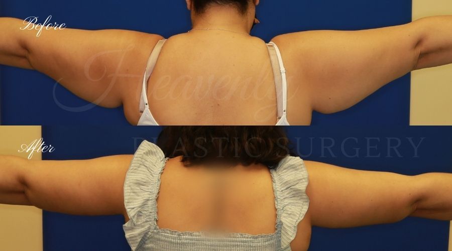 Plastic Surgery, Liposuction, Arm Lift, Brachioplasty, arms, bat wings