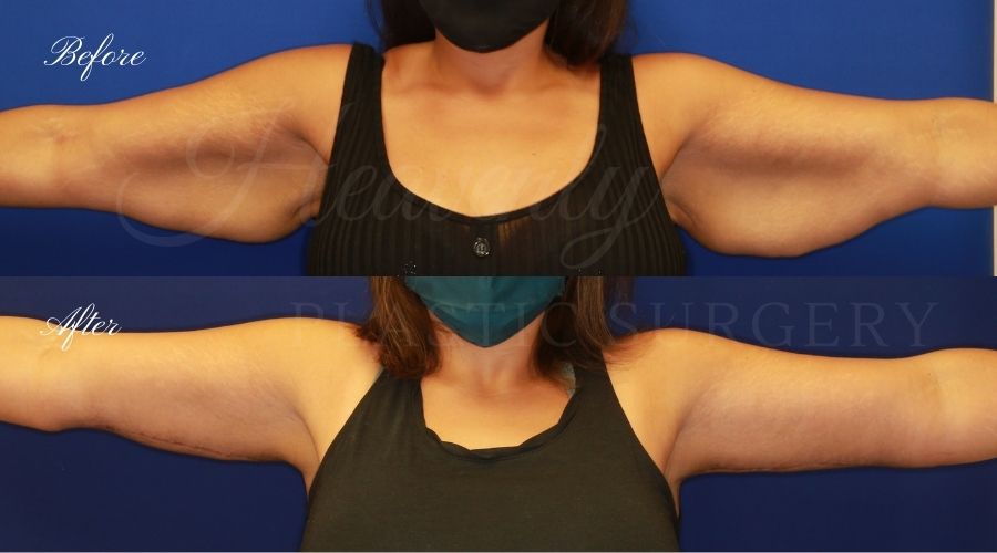 Plastic Surgery, Liposuction, Arm Lift, Brachioplasty, arms, bat wings Plastic Surgery, Liposuction, Arm Lift, Brachioplasty, arms, bat wings